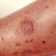 Brown recluse spider bite after 4 months of healing. I would put a fresher bite image in but they are pretty horrible looking, so maybe go Google at your own risk (Image: CDC/Pubic Domain)